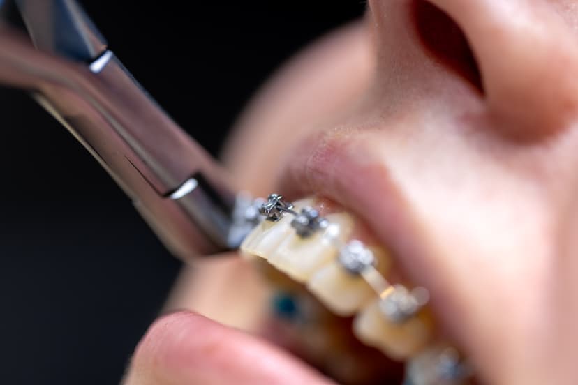 Braces & Clear Aligners (Orthodontics)